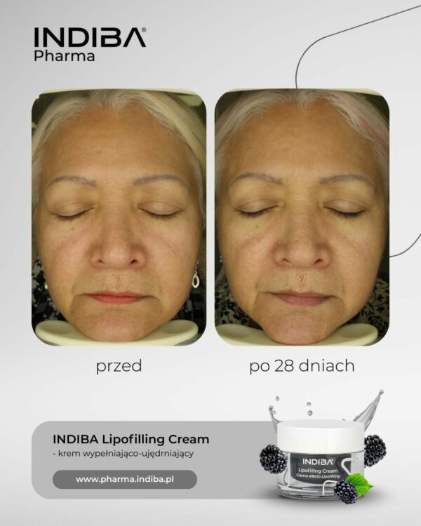 Lipoﬁlling – Image 3