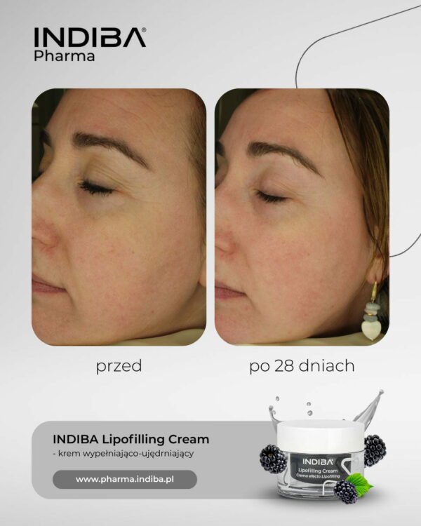Lipoﬁlling – Image 4