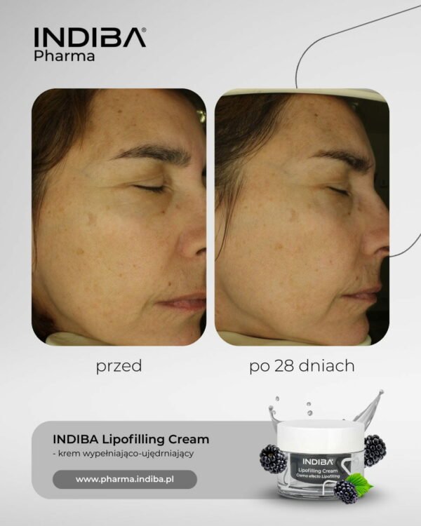 Lipoﬁlling – Image 5